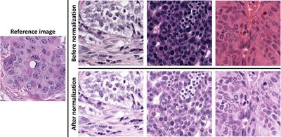 Deep Learning-Based Pathology Image Analysis Enhances Magee Feature Correlation With Oncotype DX Breast Recurrence Score